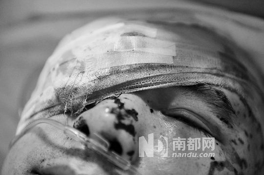 李建新頭部還有被潑硫酸的痕跡，醫(yī)生說被砍傷的右眼已經(jīng)失明。 南都記者 田飛 攝