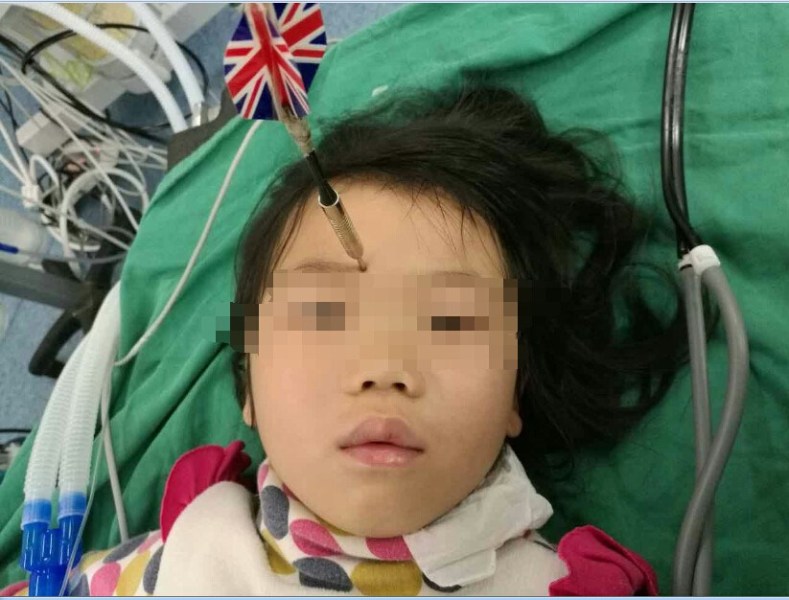 十多公分長的飛鏢穩(wěn)穩(wěn)地 ” 定 ” 在了一名六歲半的女童額頭上，小青一家人凌晨從長順趕到貴醫(yī)附院急診室時，看到如此慘烈的情況，接診醫(yī)生都嚇了一跳。詳細詢問下得知，原來是七歲的哥哥和六歲半的表妹在玩耍時，哥哥不慎將路邊撿來的真飛鏢扎到了妹妹的額頭上。