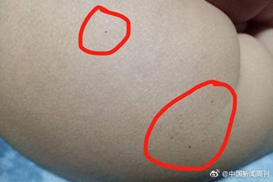 據(jù)多名紅黃藍(lán)(新天地分園)家長反映，孩子腿部、屁股、腋下出現(xiàn)針眼。