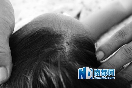 女童頭上被扎的針孔（圓圈處）。賈先生說，被扎不到三秒鐘，女兒就昏了。